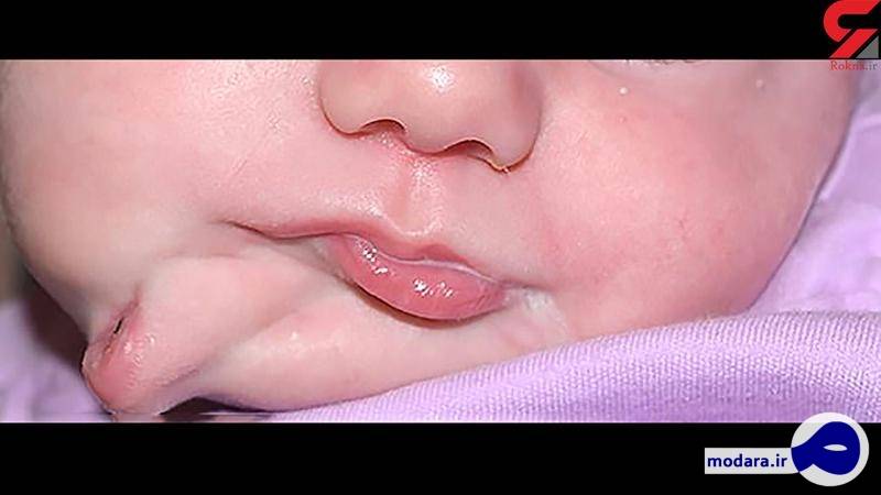 نوزادی با دو دهان به دنیا آمد+عکس