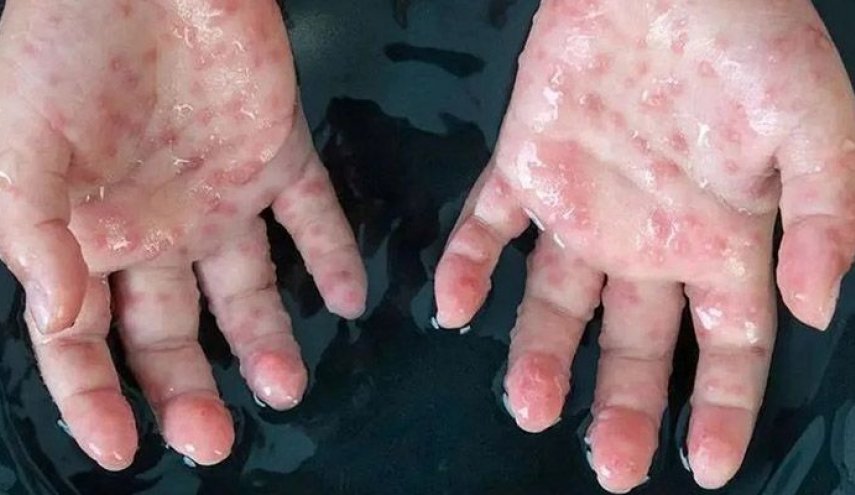 آبله میمون در همسایه جنوبی ایران شناسایی شد