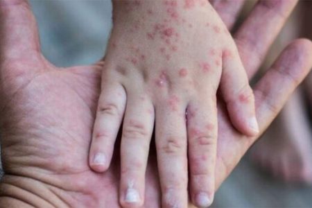 نگرانی وزارت بهداشت از انتشار بیماری «سرخک» در کشور