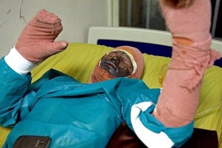 رتبه بالای ایران در بروز سوختگی با سالی ۳۰ هزار نفر / مرگ‌ومیر بالای زن‌ها در اثر سوختگی