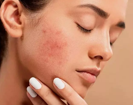 اطلاعاتی جالب در مورد جوش صورت باید بدانید