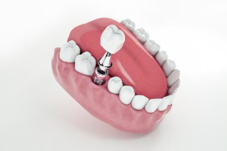 قیمت ایمپلنت یک‌روزه چقدر است؟