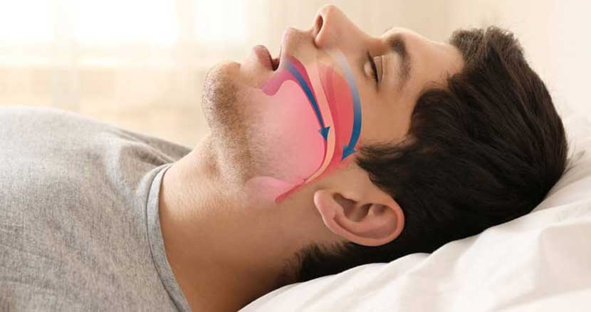 آپنه خواب دارید؟ پَس خطر سکته مغزی را جدی بگیرید