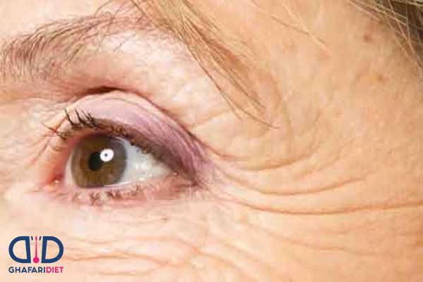 اگر چین و چروک صورت شما عمیق شده، این مطلب را بخوانید