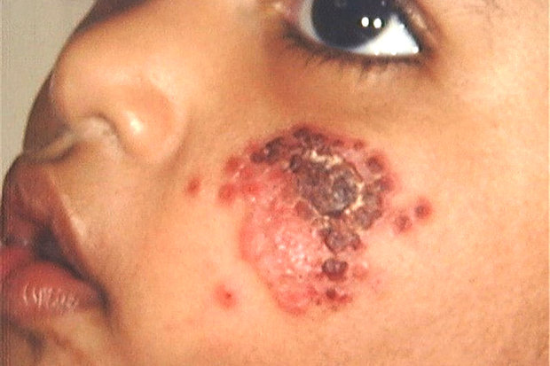 درمان زخم پیش رونده سالک در یک کودک ۲ ساله در اصفهان