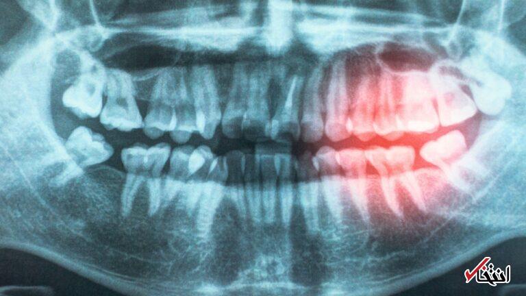 ارتباط بیماری لثه با افزایش خطر بیماری‌های قلبی