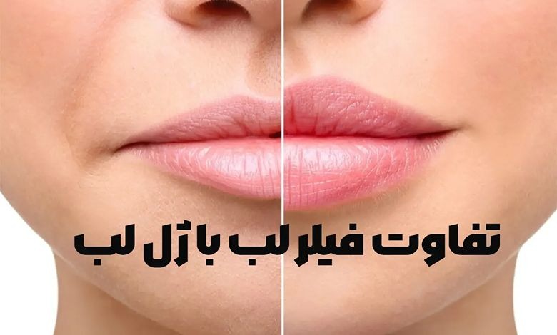 تفاوت فیلر لب با ژل لب
